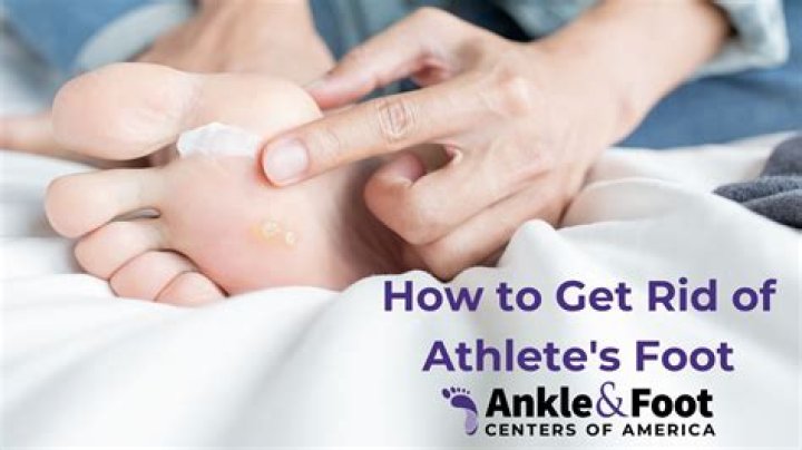 11 Ways to Get Rid of Athlete's Foot, According to Experts