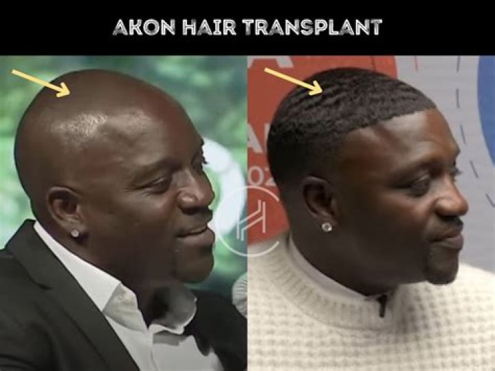 Akon roasted for Turkey hair transplant and is dubbed 'Lego man'