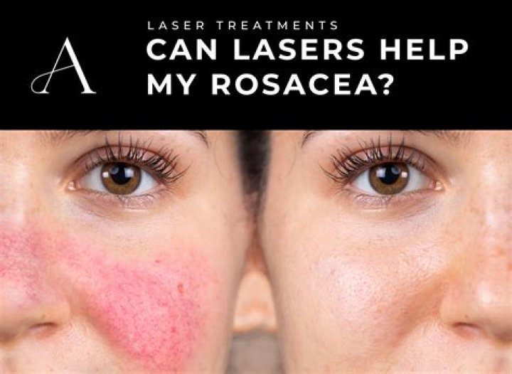 An Expert-Approved Skin Routine That Can Help With Rosacea