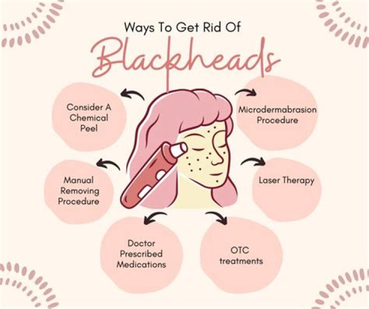 Can You Ever Really Get Rid of Blackheads? We Investigate