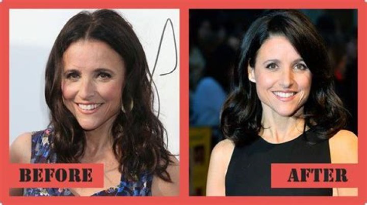 Did Julia Louis-Dreyfus Have Plastic Surgery? Photos