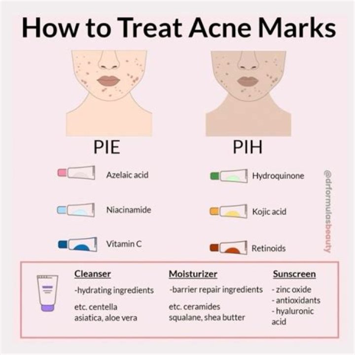 How to Treat Hormonal Acne on Your Chin, According to Dermatologists