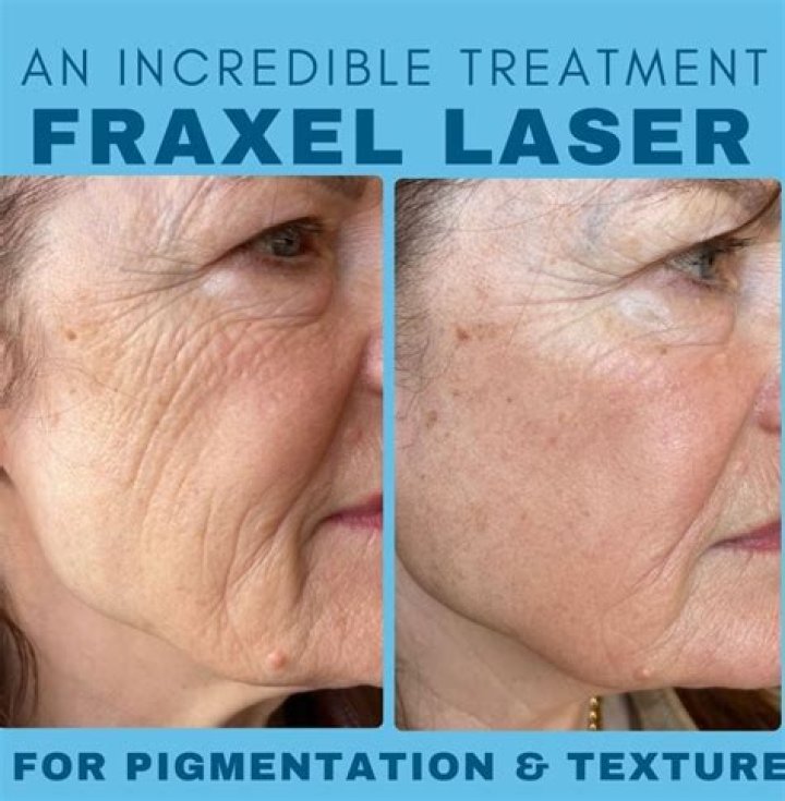 I Got Fraxel Laser Treatment—Here's What You Need to Know