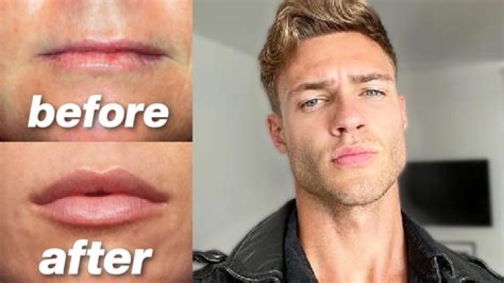 Man With Lips So Big He Can't Close His Mouth Wants More Injections