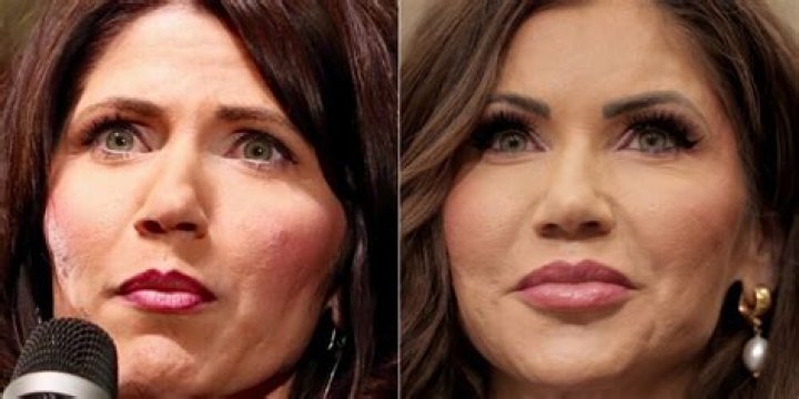 Sarah Palin Plastic Surgery: Her Pictures Before And After Surgery